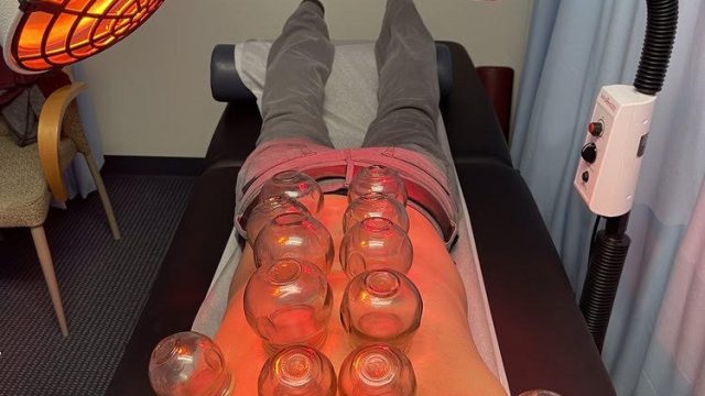 Cupping-Picture