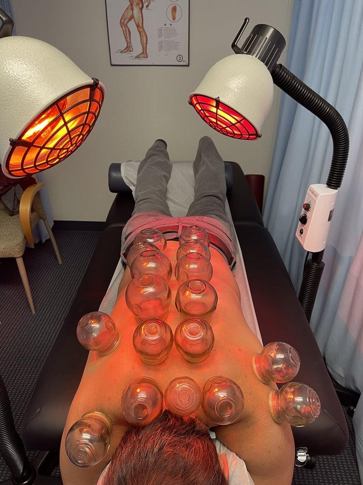 Cupping-Picture